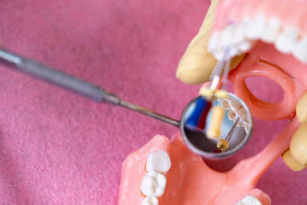 Glasjonomery – wady i zalety na tle innych materiałów do wypełnień